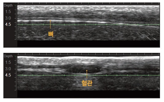 부산 울쎄라 슈링크 비교_03.jpg