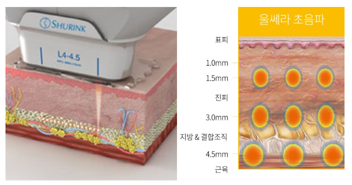 부산 울쎄라 슈링크 비교_02.jpg