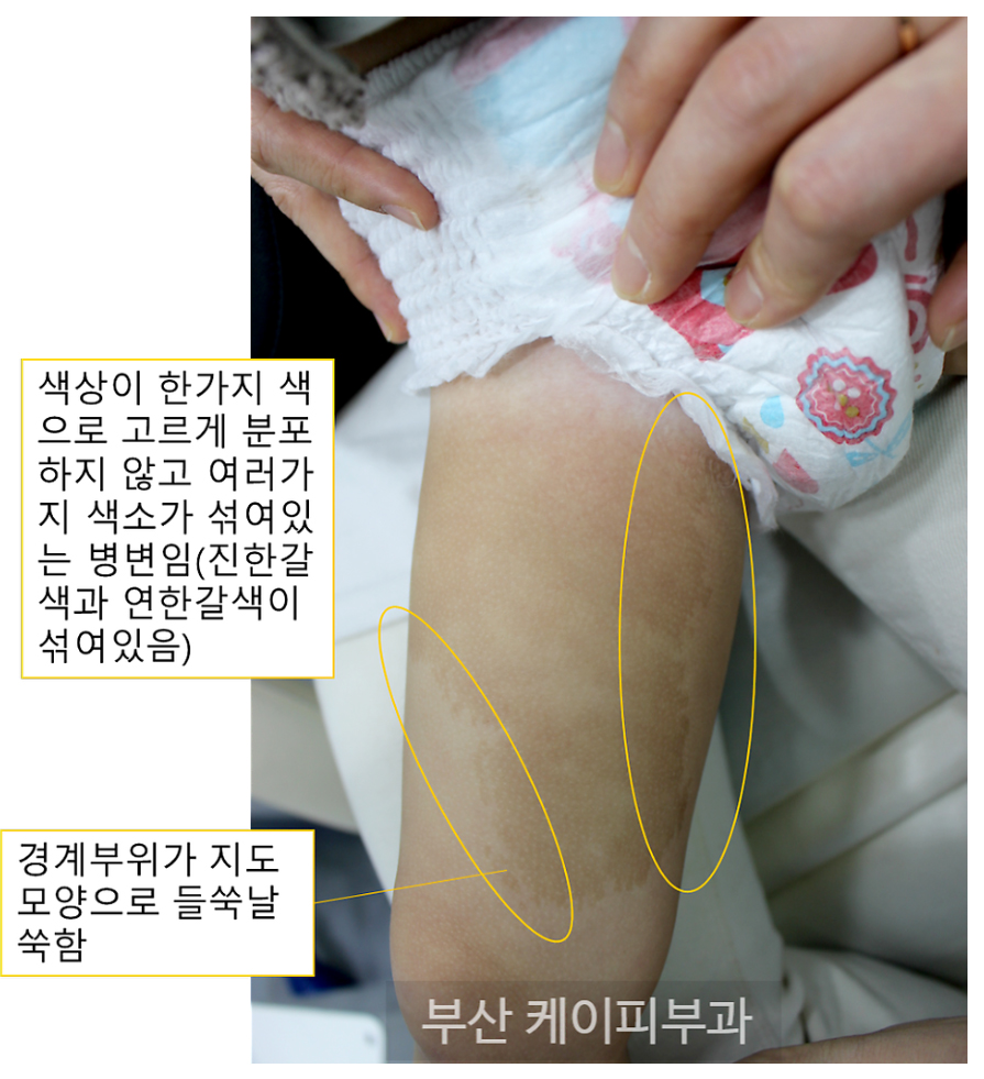 부산 아기 미르커피반점 레이저 치료 후기_03.jpg