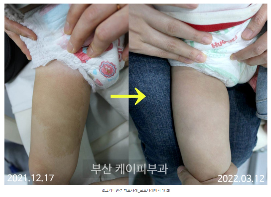 부산 아기 미르커피반점 레이저 치료 후기_02.jpg