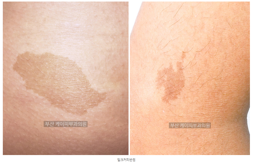 부산 아기 미르커피반점 레이저 치료 후기_01.jpg