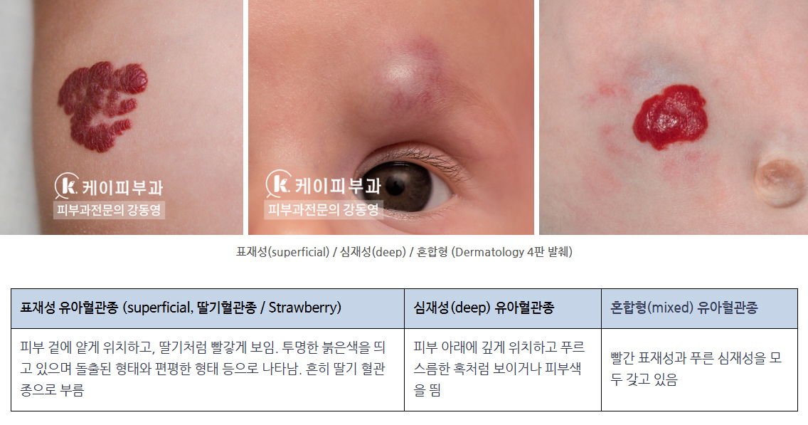 부산 신생아 빨간점 혈관종 (유아혈관종) 치료_02.jpg