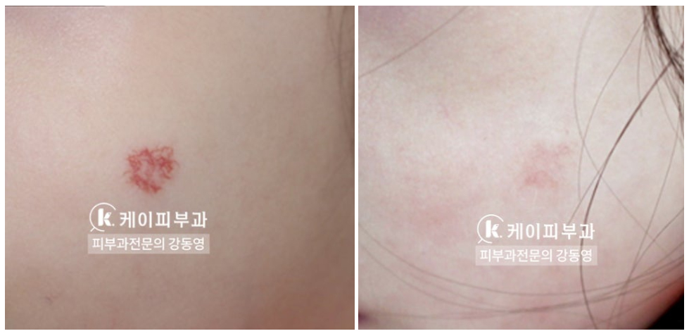 부산 신생아 빨간점 혈관종 (유아혈관종) 치료_04.jpg