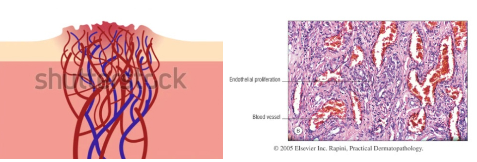 부산 신생아 빨간점 혈관종 (유아혈관종) 치료_01.jpg