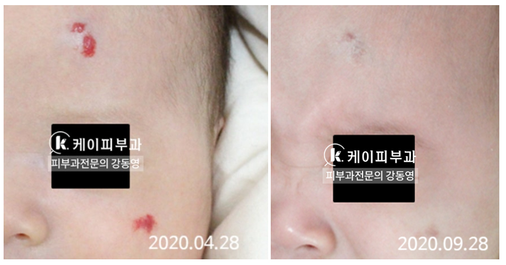 부산 신생아 빨간점 혈관종 (유아혈관종) 치료_03.jpg