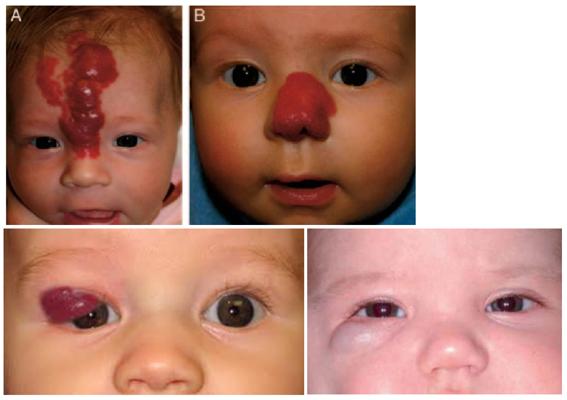 부산 신생아 빨간점 혈관종 (유아혈관종) 치료_06.jpg