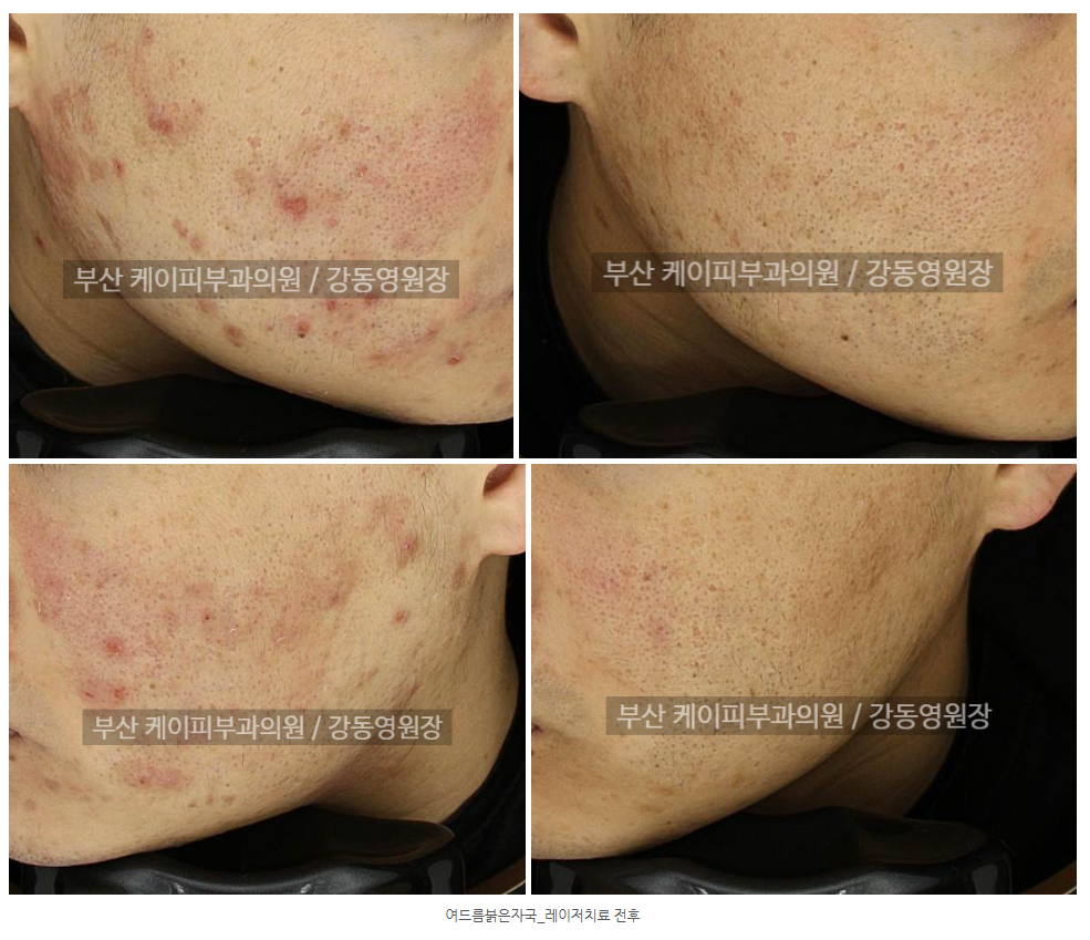 부산 여드름 붉은자국_03.jpg