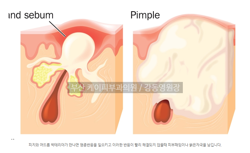 부산 여드름 붉은자국_01.jpg