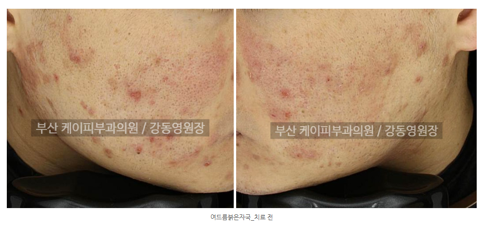 부산 여드름 붉은자국_02.jpg