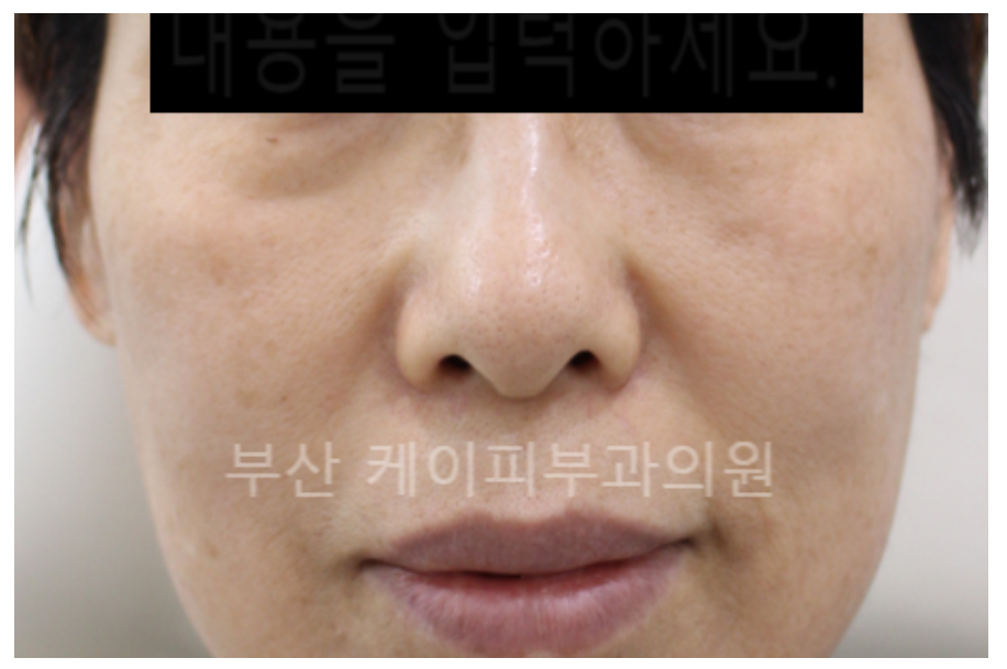 부산 턱끝, 관자놀이, 광대, 눈밑고랑 필러 시술 후기_03.jpg