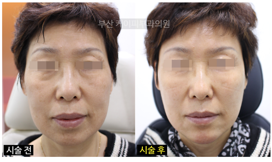 부산 턱끝, 관자놀이, 광대, 눈밑고랑 필러 시술 후기_01.jpg