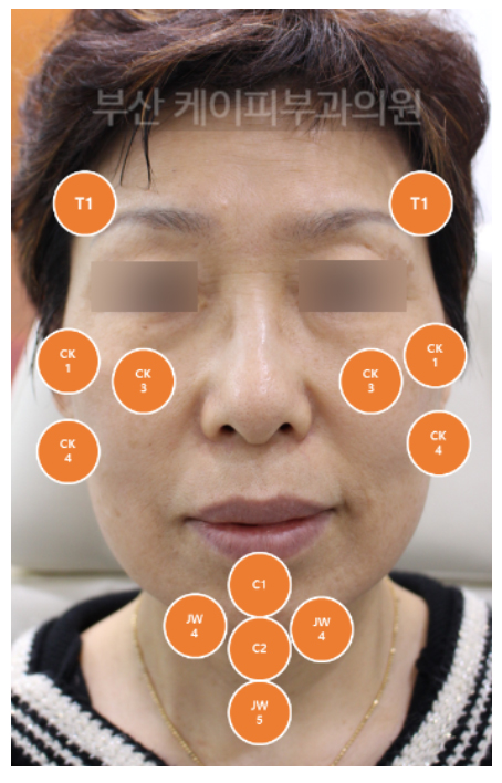 부산 턱끝, 관자놀이, 광대, 눈밑고랑 필러 시술 후기_02.jpg