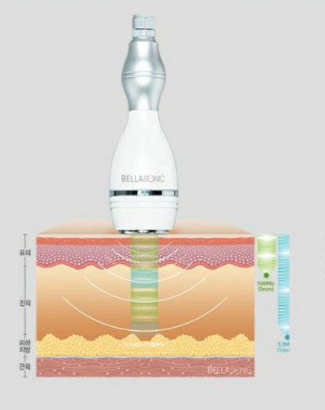 부산케이피부과_벨라소닉_벨라소노_2.png