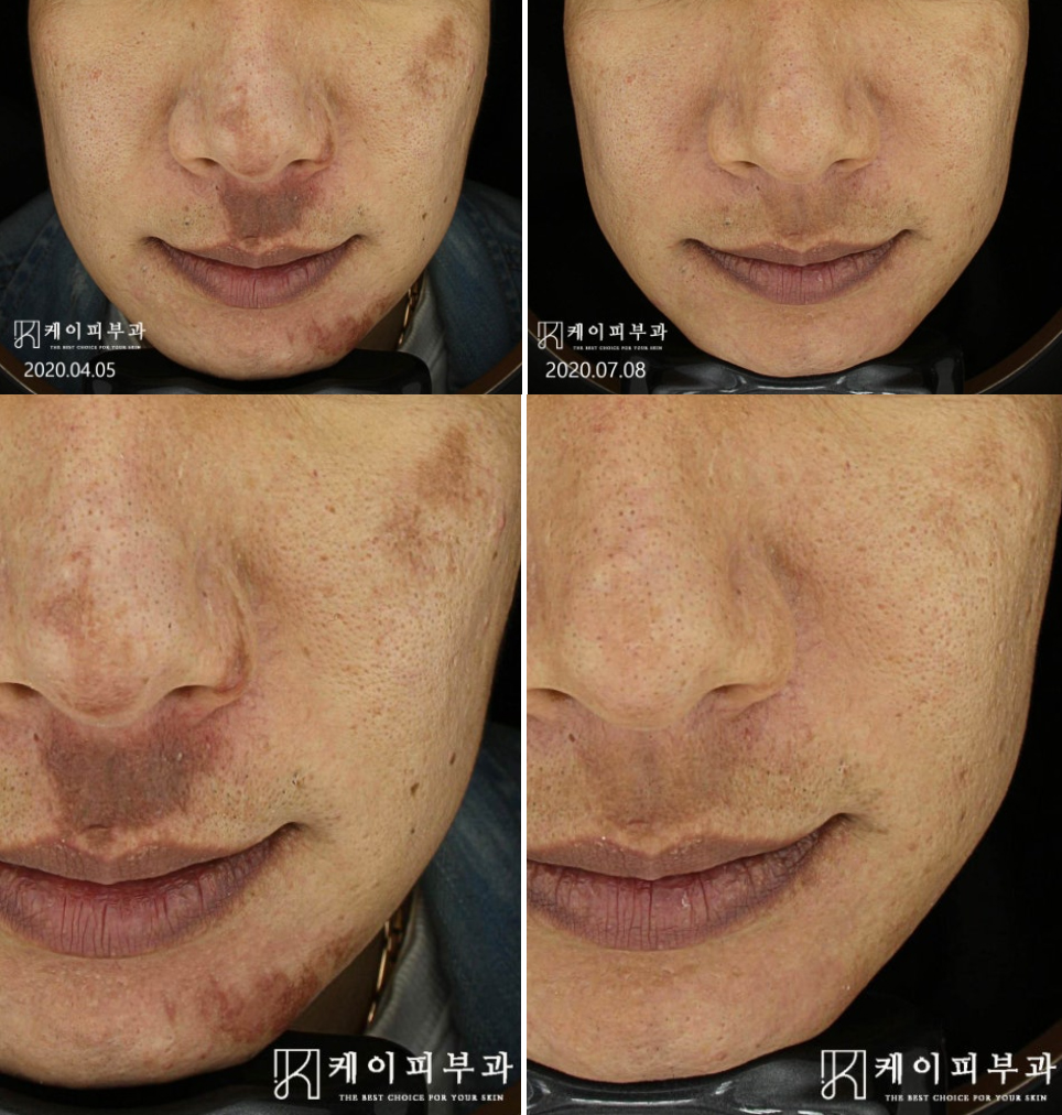 부산 레블라이트토닝 10회 전후 PIH 치료_01.jpg