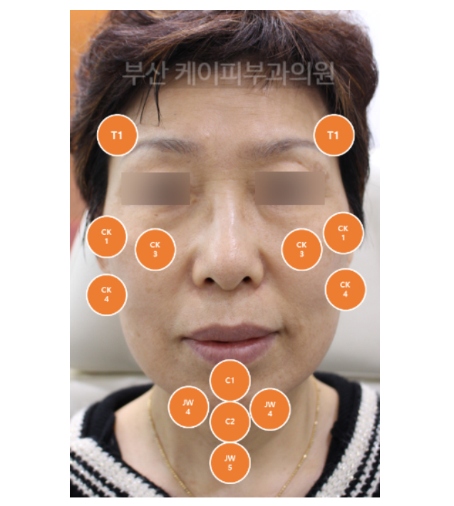 부산 관자놀이, 볼, 광대, 눈밑고랑, 팔자주름 턱끝 필러_02.jpg