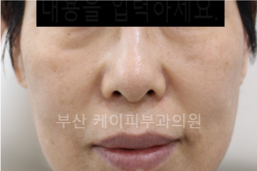 부산 관자놀이, 볼, 광대, 눈밑고랑, 팔자주름 턱끝 필러_03.jpg