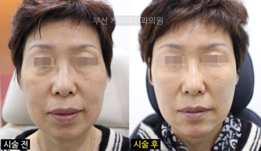 부산 관자놀이, 볼, 광대, 눈밑고랑, 팔자주름 턱끝 필러_01.jpg