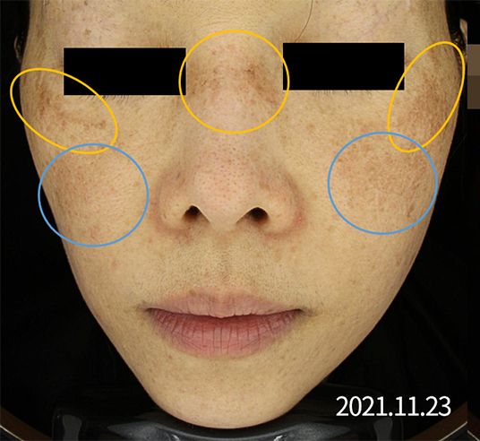 레이저토닝 부작용 치료사례_02.jpg