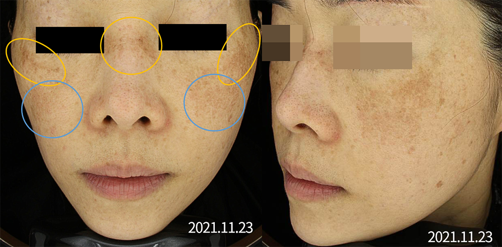 레이저토닝 부작용 치료사례_01.png