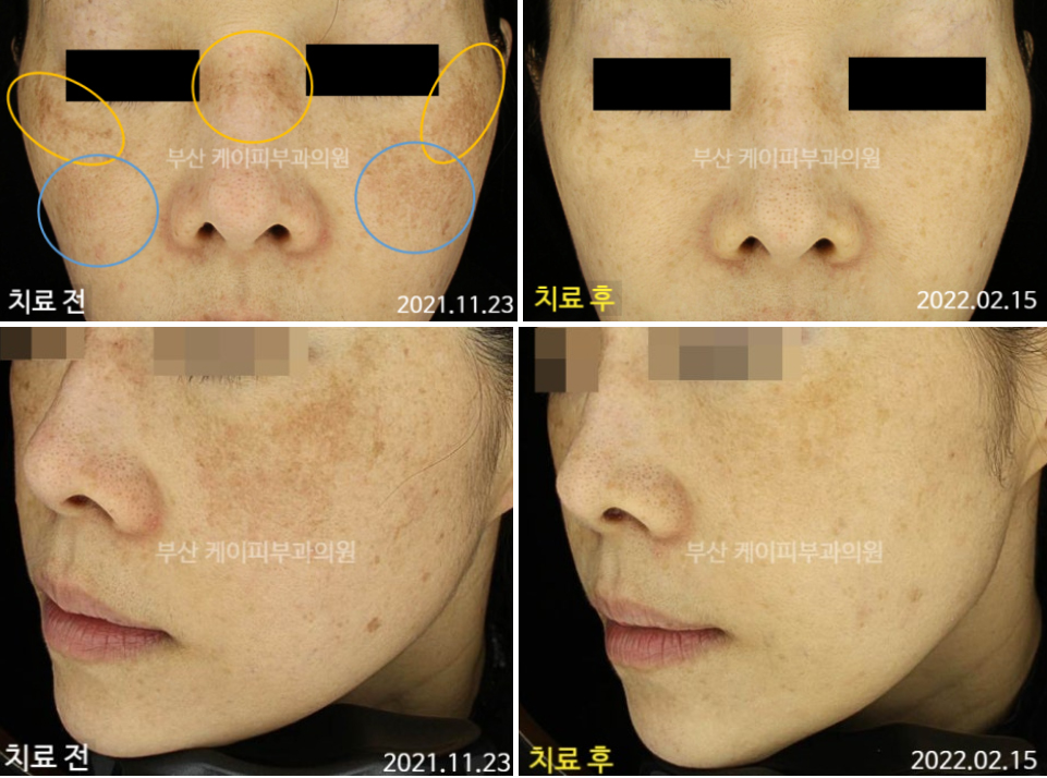 레이저토닝 부작용 치료사례_06.jpg