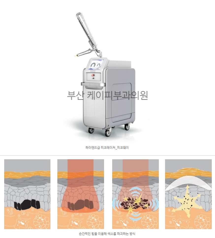 문신제거 레이저 치료 방법 _02.jpg