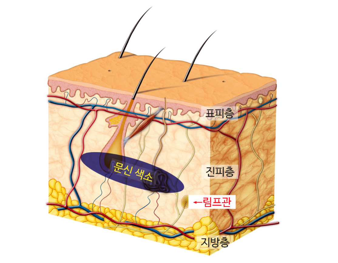 문신제거 레이저 치료 방법 _01.jpg