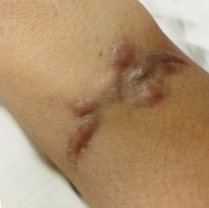 문신제거 레이저 치료 방법 _05.jpg