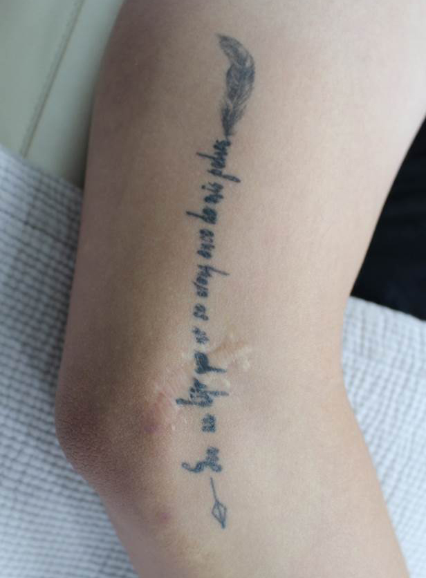 문신제거 레이저 치료 방법 _03.jpg