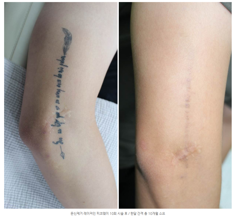 문신제거 레이저 치료 방법 _04.jpg