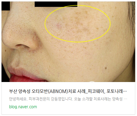 부산 기미레이저치료 시 레이저토닝, 피코토닝, 제네시스토닝_05.jpg