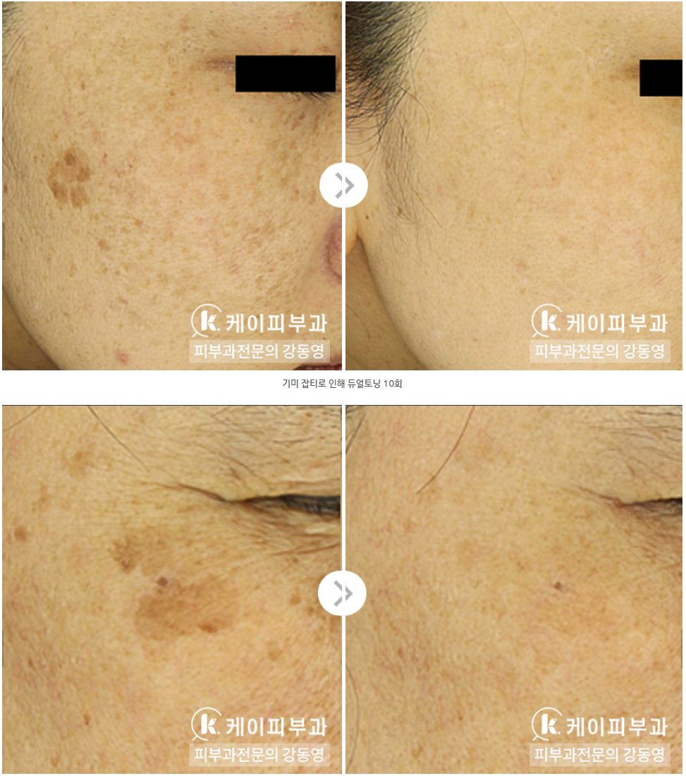 부산 기미레이저치료 시 레이저토닝, 피코토닝, 제네시스토닝_07.jpg