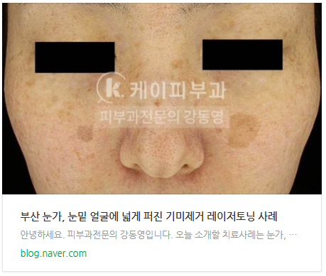 부산 기미레이저치료 시 레이저토닝, 피코토닝, 제네시스토닝_03.jpg