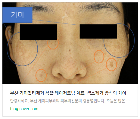 부산 기미레이저치료 시 레이저토닝, 피코토닝, 제네시스토닝_01.jpg