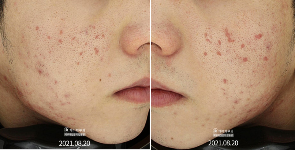 TCA도트필 부작용_02.jpg