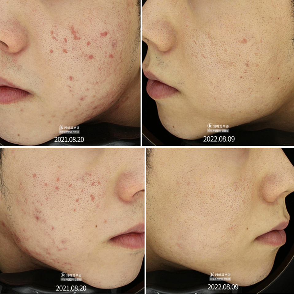 TCA도트필 부작용_03.jpg