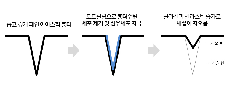 TCA도트필 부작용_01.jpg