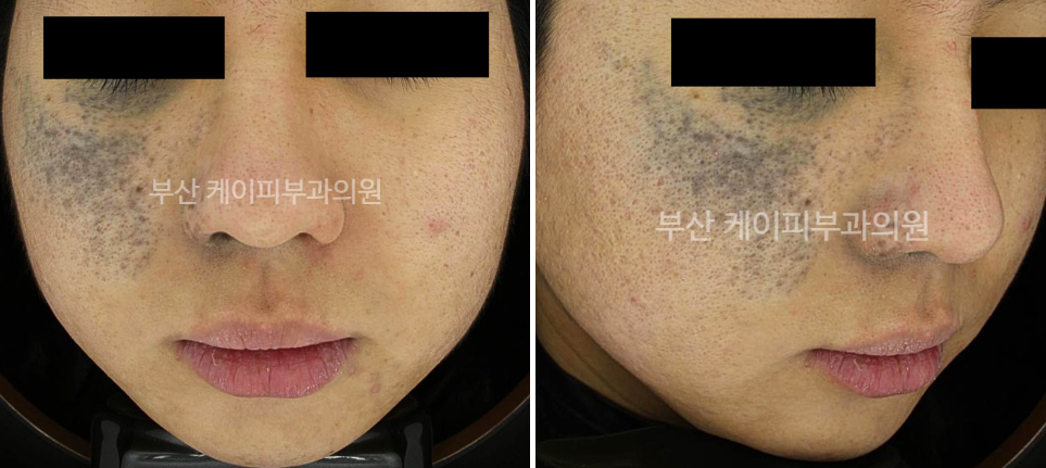 부산 오타모반 레이저 치료_02.jpg