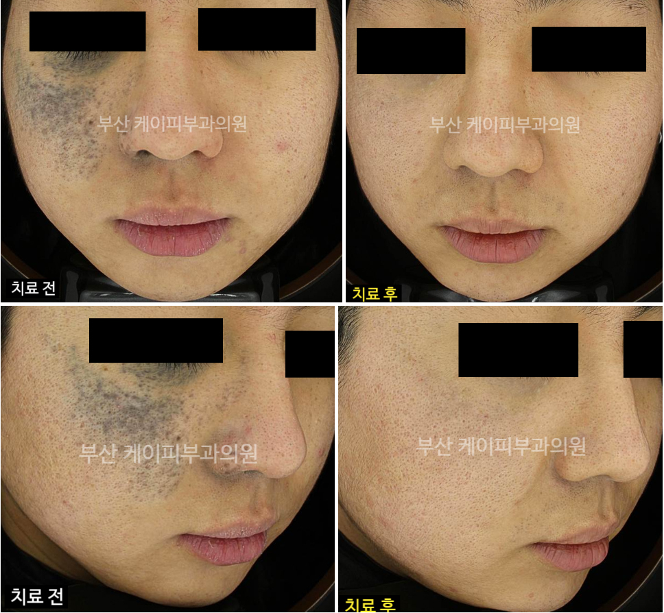 부산 오타모반 레이저 치료_03.jpg