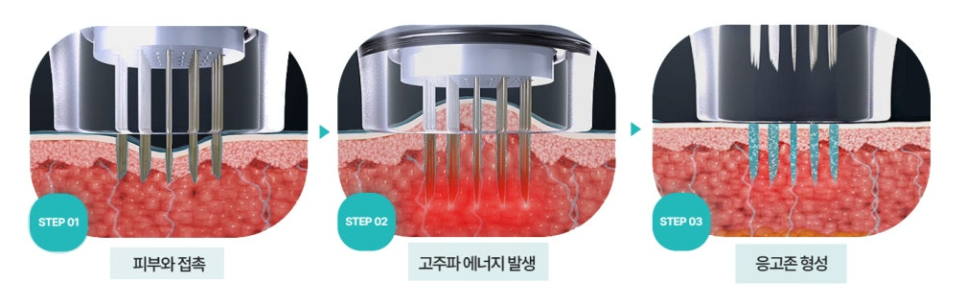 부산해운대_니들고주파_포텐자_원리_효과_작용_포텐자_원리1.png
