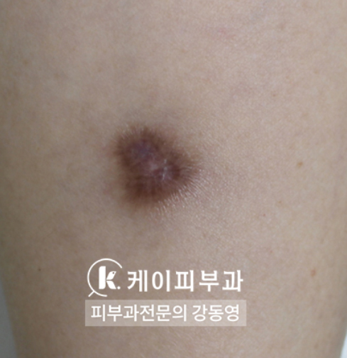 부산 흉터레이저치료_화상흉터 패인흉터 붉은흉터_02.jpg