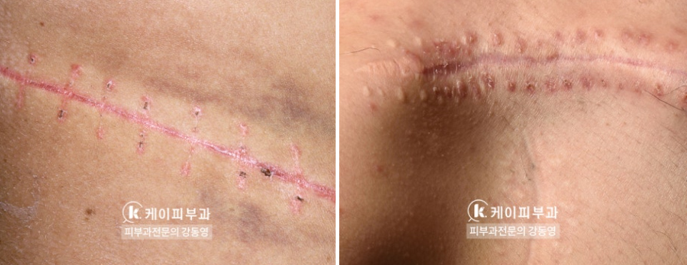 부산 흉터레이저치료_화상흉터 패인흉터 붉은흉터_03.jpg