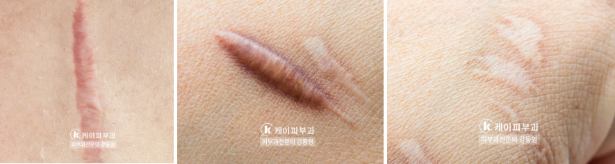 부산 흉터레이저치료_화상흉터 패인흉터 붉은흉터_05.jpg