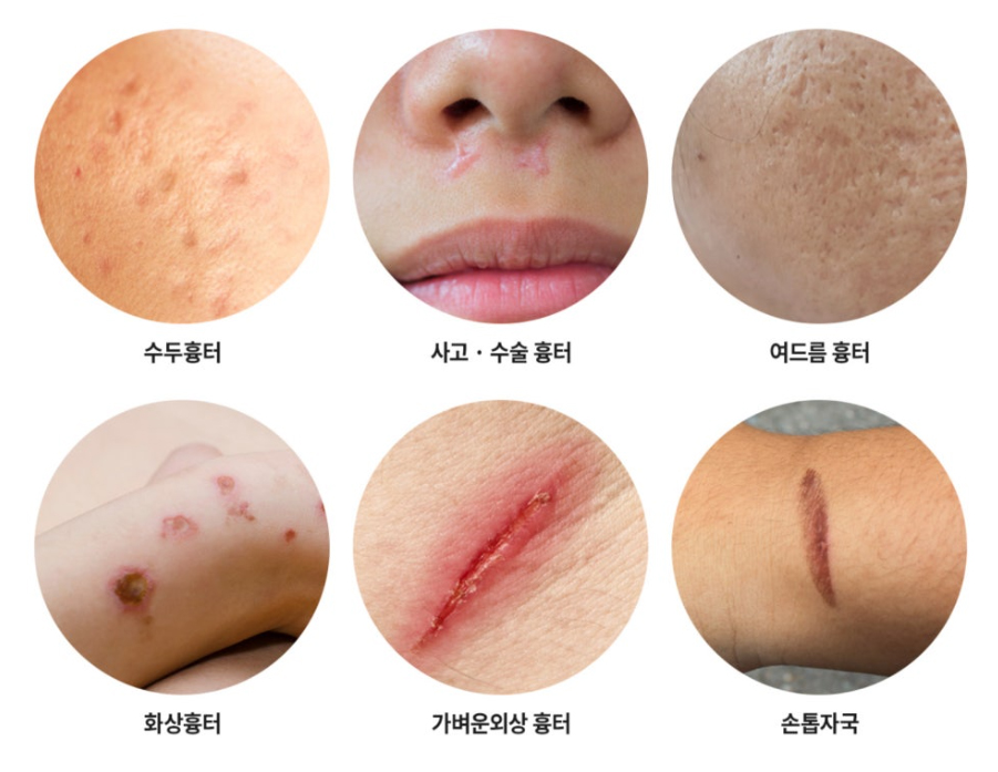 부산 흉터레이저치료_화상흉터 패인흉터 붉은흉터_01.jpg