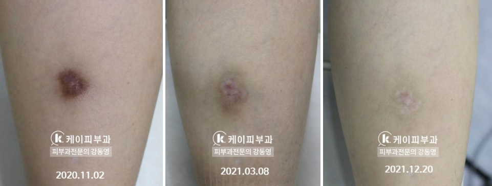 부산 흉터레이저치료_화상흉터 패인흉터 붉은흉터_07.jpg