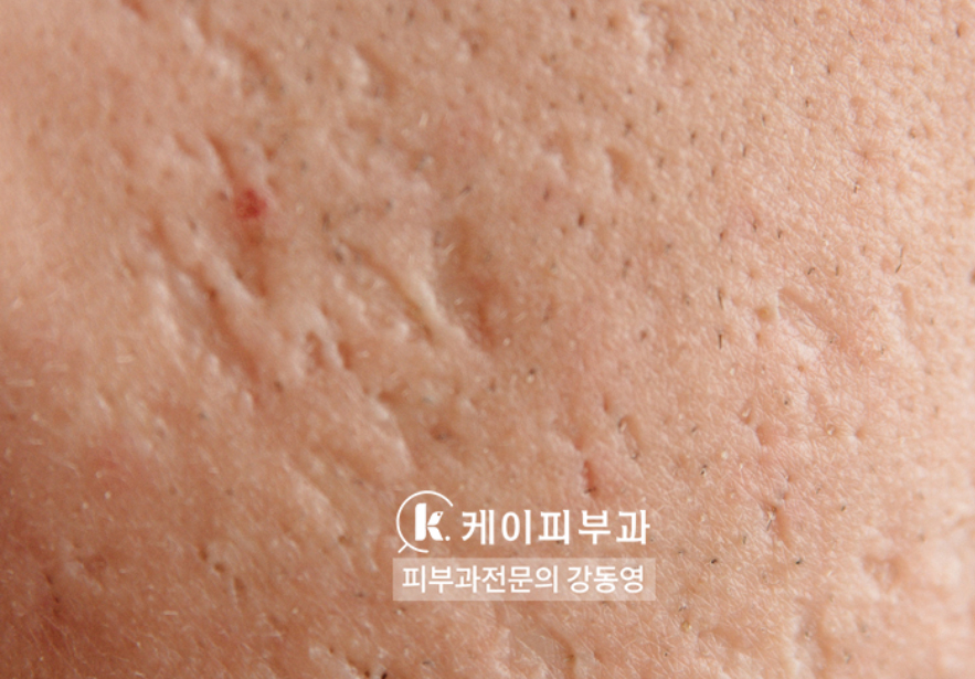 부산 흉터레이저치료_화상흉터 패인흉터 붉은흉터_06.jpg