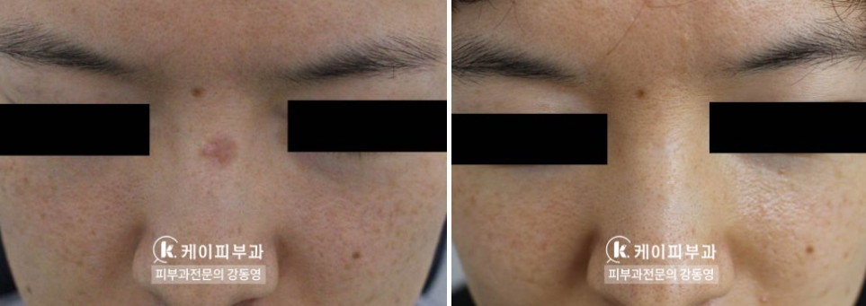 부산 흉터레이저치료_화상흉터 패인흉터 붉은흉터_08.jpg