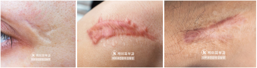 부산 흉터레이저치료_화상흉터 패인흉터 붉은흉터_04.jpg