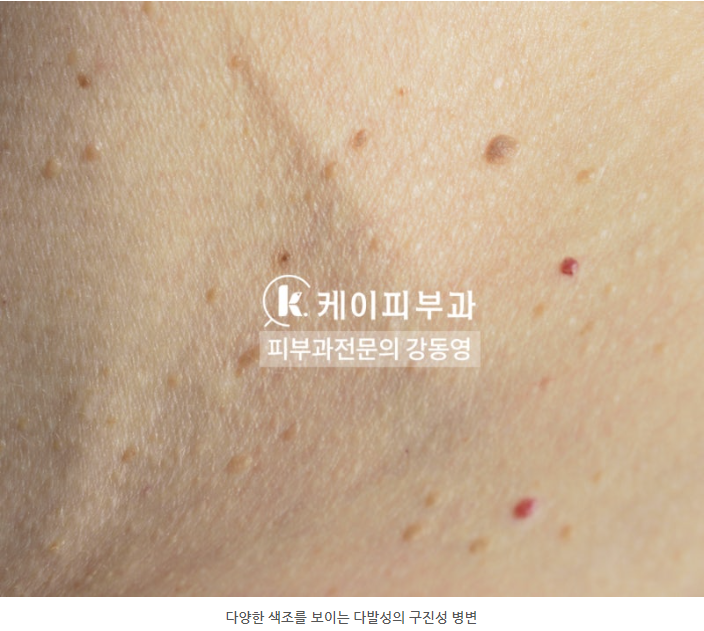 부산 편평사마귀 레이저 제거_01.png