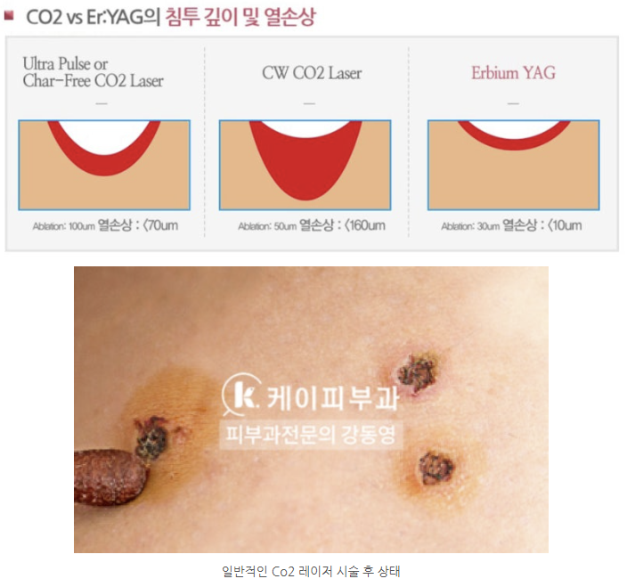 부산 편평사마귀 레이저 제거_04.png