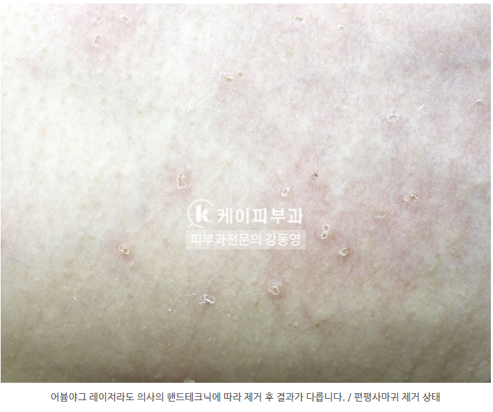 부산 편평사마귀 레이저 제거_05.png